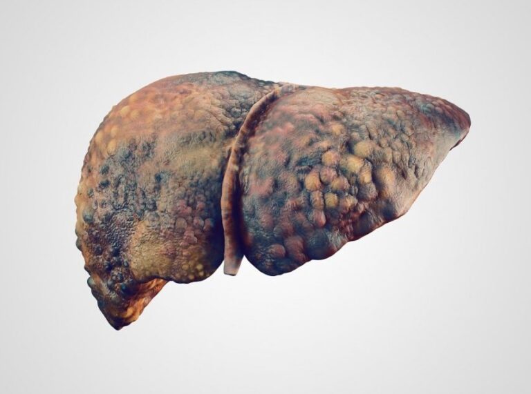 Is There a Role for GLP-1RAs in NAFLD Management?